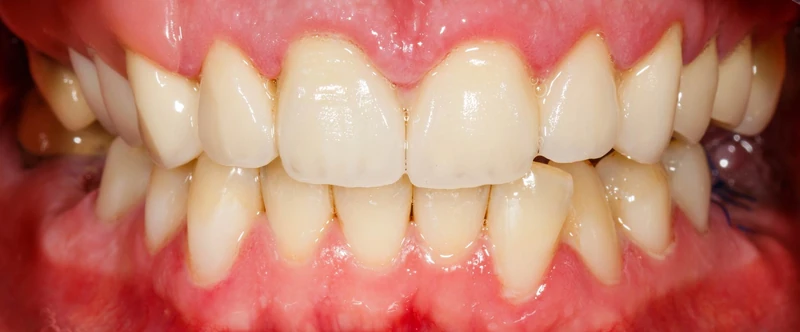 After smile restoration case 6: the same patient's teeth after treatment at Omni Dental