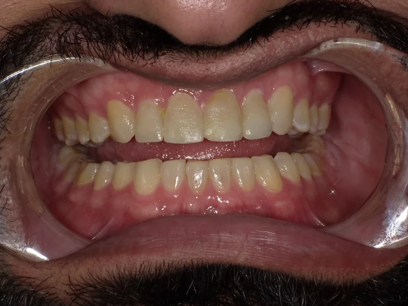 Before smile restoration case 7: an Omni Dental patient's teeth before treatment