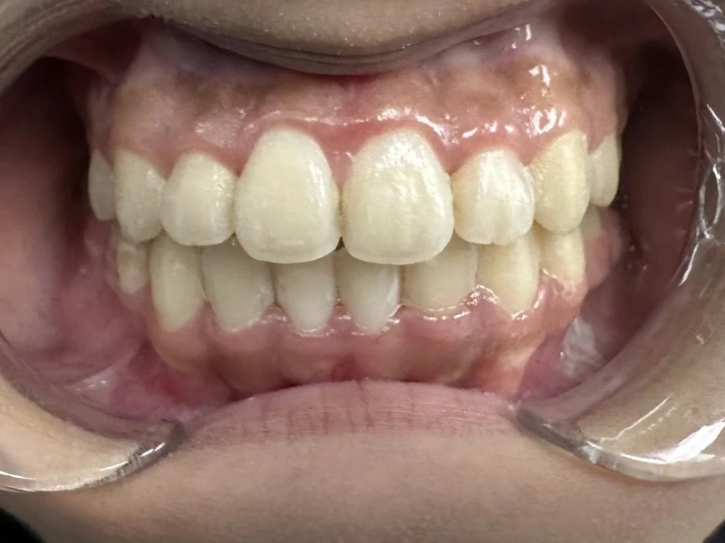 After smile restoration case 8: the same patient's teeth after treatment at Omni Dental