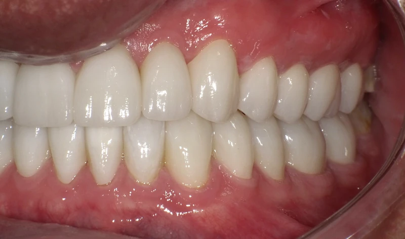 After smile restoration (left side view): the same patient's teeth after treatment at Omni Dental