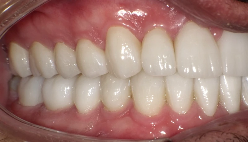 After smile restoration (right side view): the same patient's teeth after treatment at Omni Dental