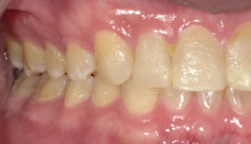 Before smile restoration (right side view): an Omni Dental patient's teeth before treatment