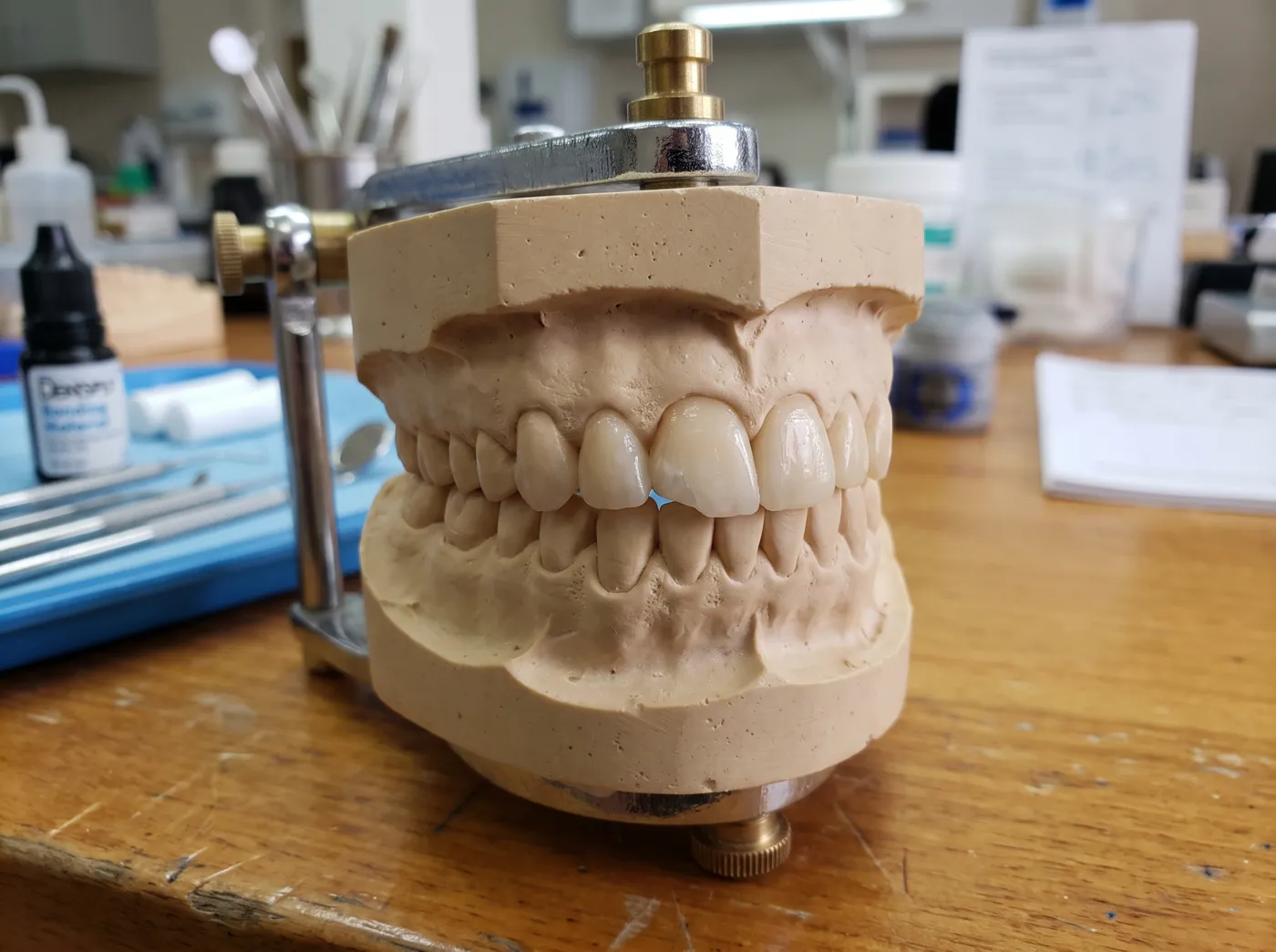 Dental bonding front tooth at Omni Dental in Arlington Heights, IL