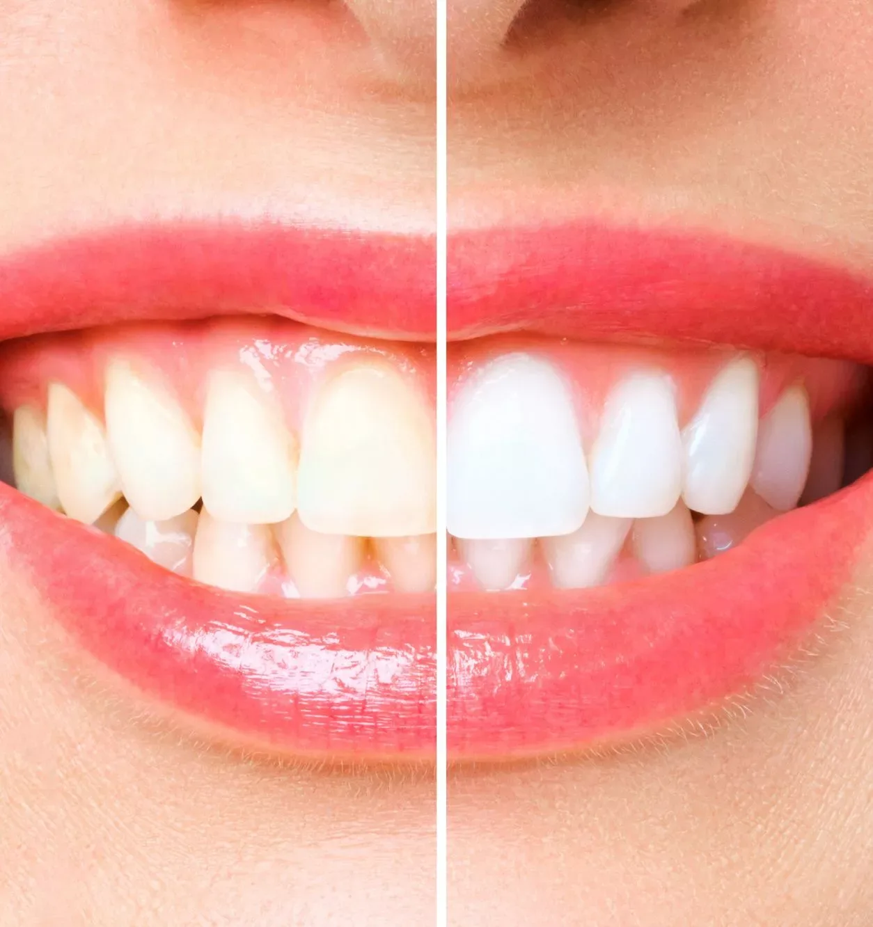 Before and after whitening: one half of a smile shows yellowed teeth and the other half shows the same teeth several shades whiter