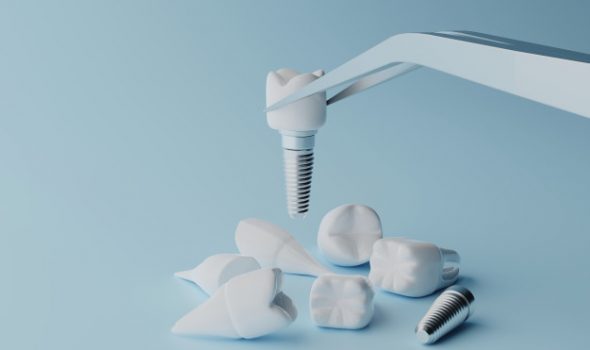 Dental Implant Faqs