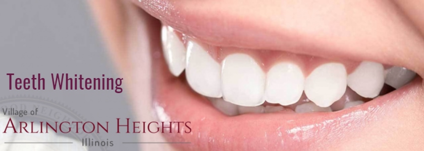 Teeth whitening in Arlington Heights IL
