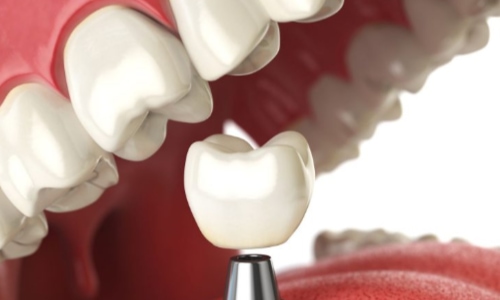 dental implants in Arlington Heights