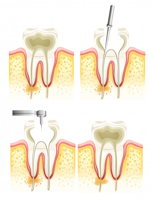 root-canal-process