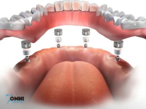 Cost Of Dental Implants in Arlington Heights IL