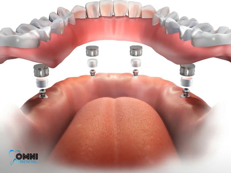 Cost Of Dental Implants in Arlington Heights IL