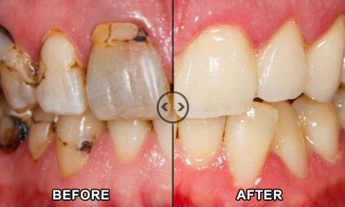 befoe-after-omni dental