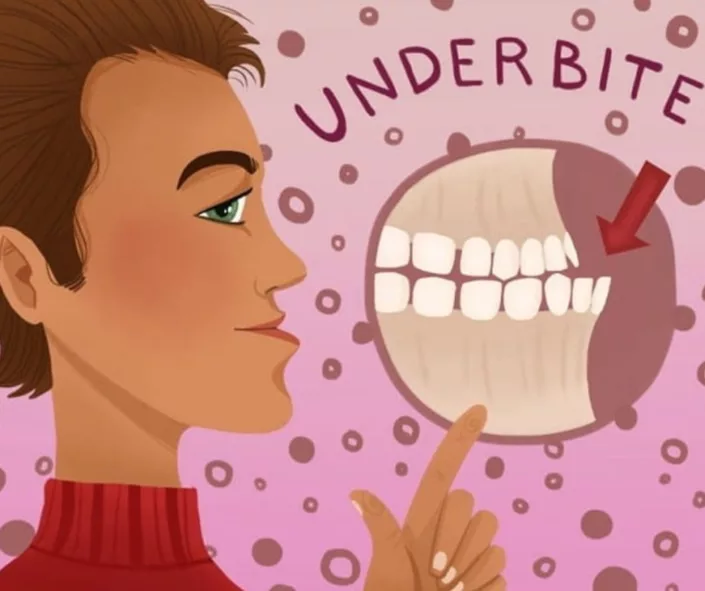 how does invisalign fix underbite