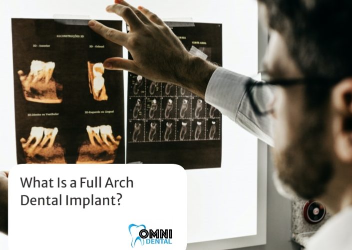 what is a full arch dental implants