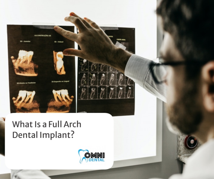 what is a full arch dental implants