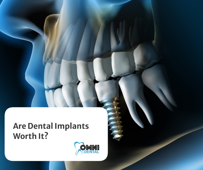 Are Dental Implants Worth It