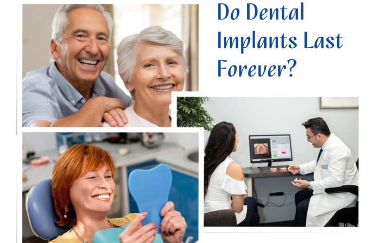 Do Dental Implants Last Forever