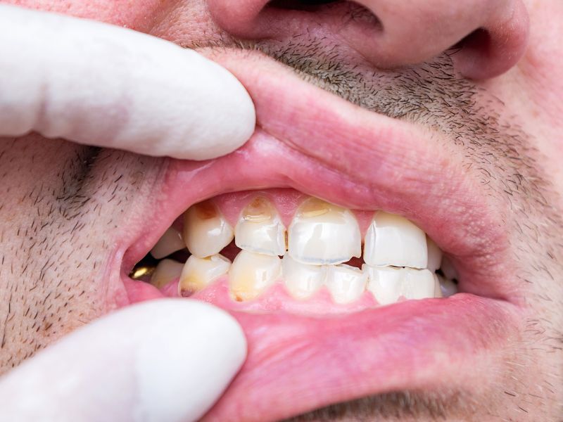 What Are The Signs Of Enamel Damage?