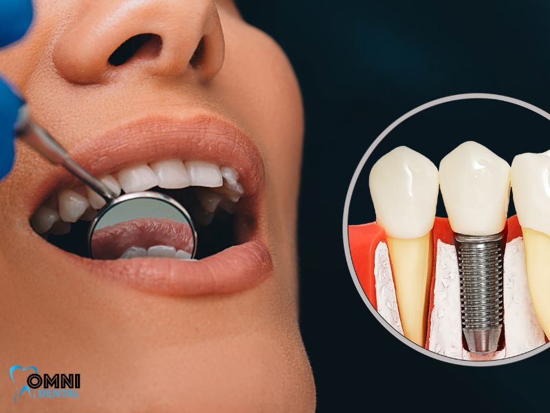 All-on-4 Dental Implants in Arlington Heights