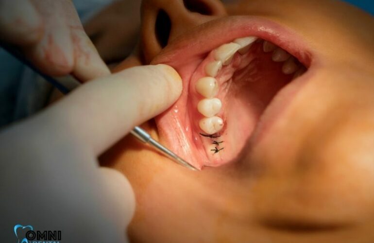 Full-Arch Dental Implants