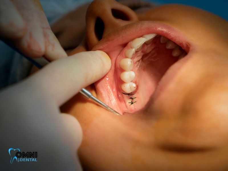 Full-Arch Dental Implants