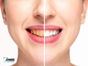 Teeth Whitening Arlington Heights, IL