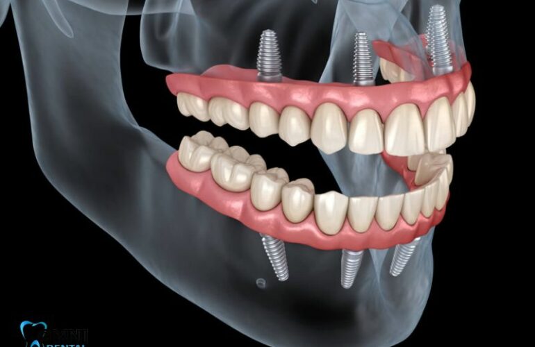 Can you put a temporary tooth while waiting for an implant?