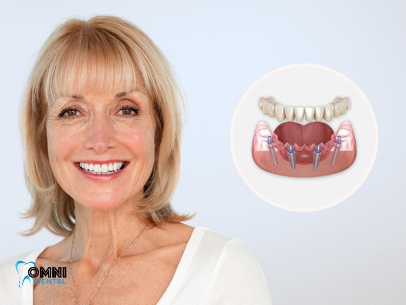 Local All-on-4 Dental Implants in nw chicago suburbs