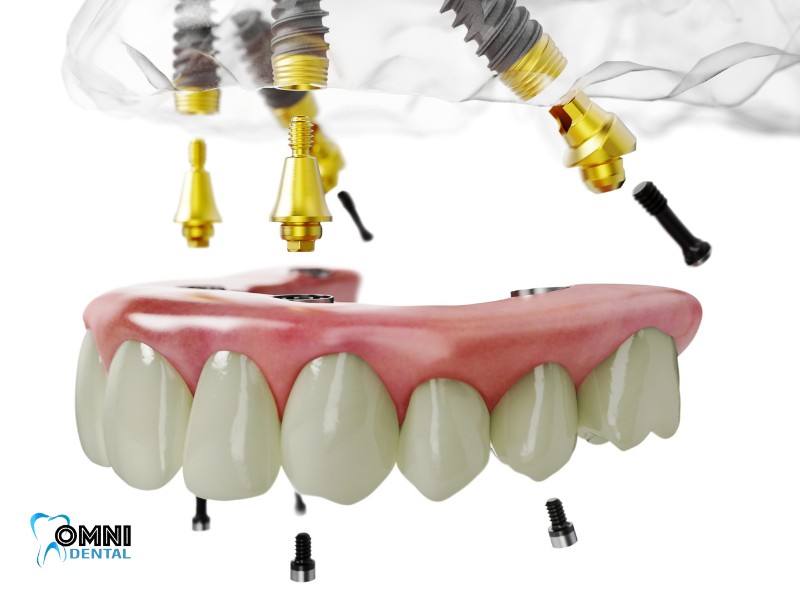 all-on-4 dental implants step by step