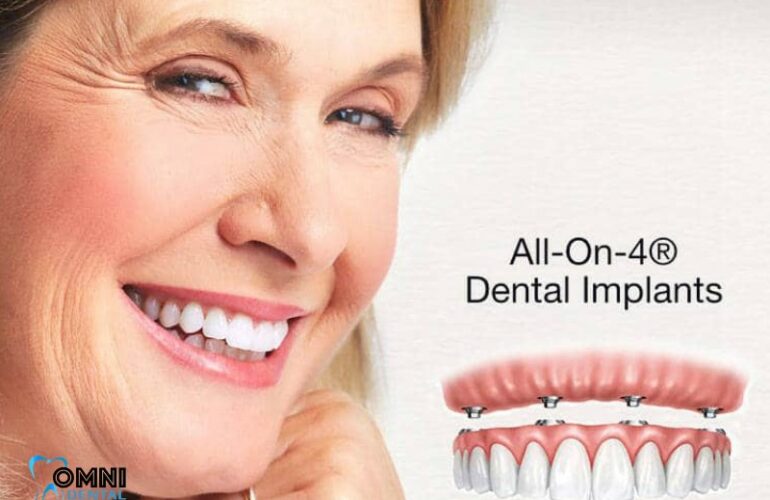 All-on-4 Dental Implants Step by Step