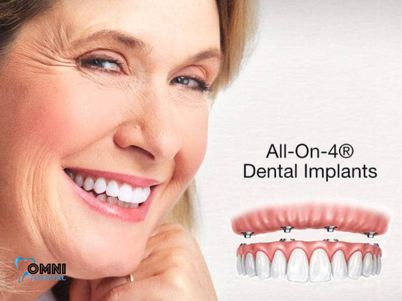 All-on-4 Dental Implants Step by Step