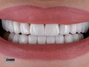 Can you whiten porcelain veneers?