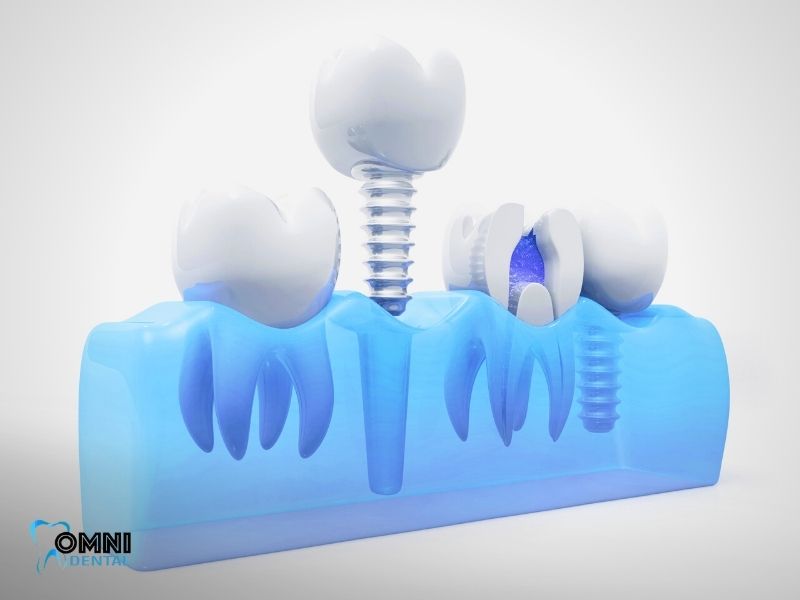 Customizing Your Dental Implants Procedure