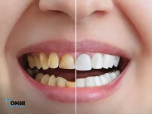 10 Key Facts About Teeth Whitening