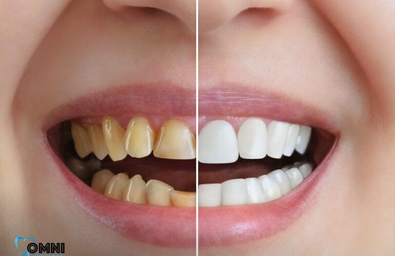10 Key Facts About Teeth Whitening