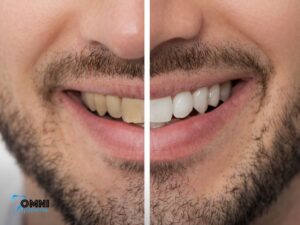 Who Is a Good Candidate for Teeth Whitening?