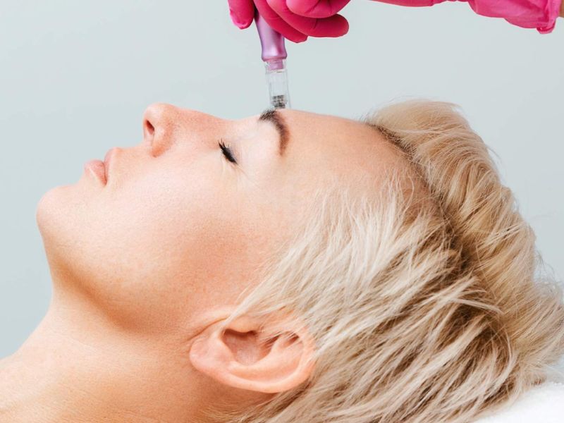 Microneedling services