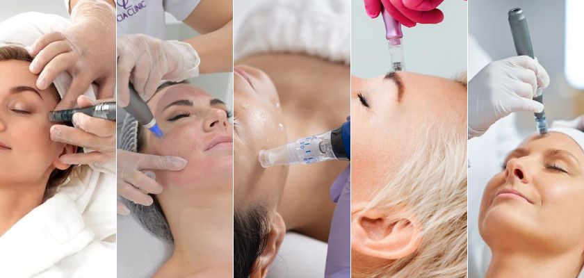 Microneedling In Arlington Heights