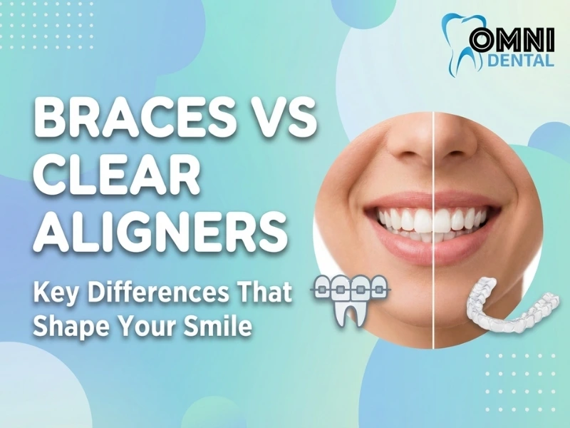 Choosing Between Braces and Clear Aligners- Omni Dental Of Arlington ...
