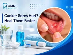 Understanding Canker Sores and Treatment Options